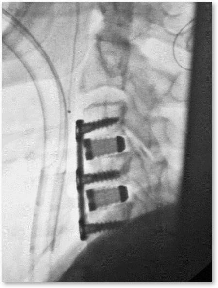 IdentiTi-C Porous Titanium Interbody Implant