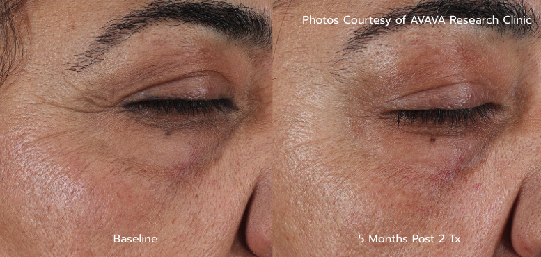 Wrinkle B&A - 5 Months Post 2 Tx