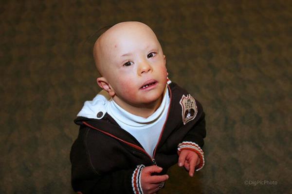 Oliver has had alopecia areata since early childhood. (Photo Credit: DigPicPhoto)