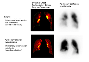 CTEPH diagnosis with Dynamic Digital Radiography