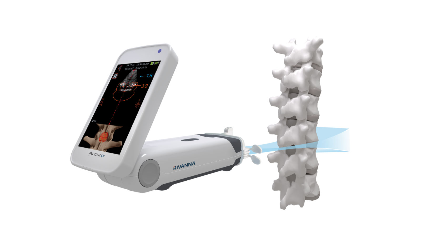 Accuro's SpineNav3D Epidural Guidance