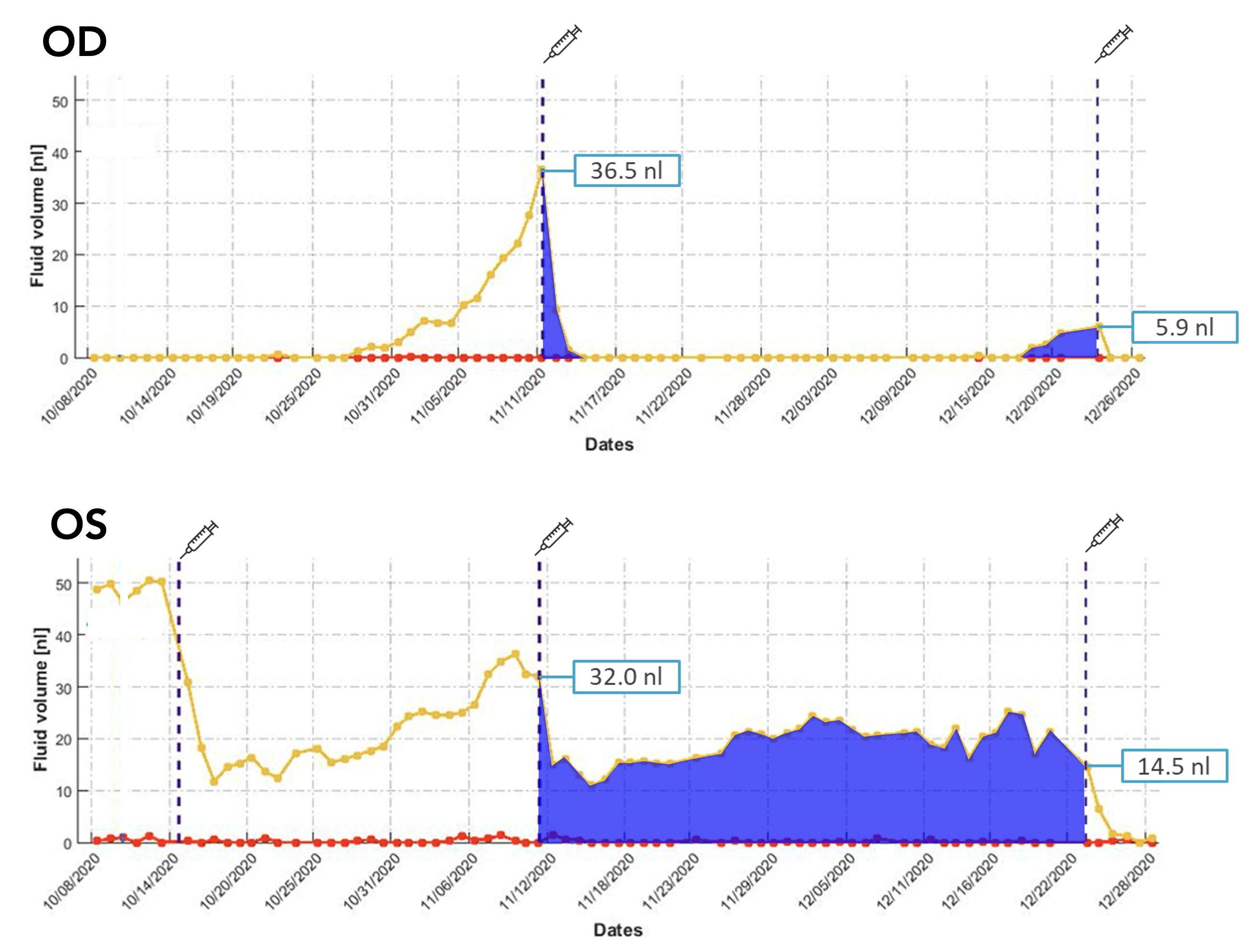 Figure: Intraretinal fluid (red) and subretinal fluid (yellow) volume trajectories from Notal OCT Analyzer (NOA) segmentation of daily home OCT self-images of a patients right and left eye. Retinal fluid exposure described by the area under the curve between treatments (syringe) differs significantly between eyes despite similar fluid volumes measured on the day of office treatment visits illustrating the medical insights gained from daily OCT imaging at home.