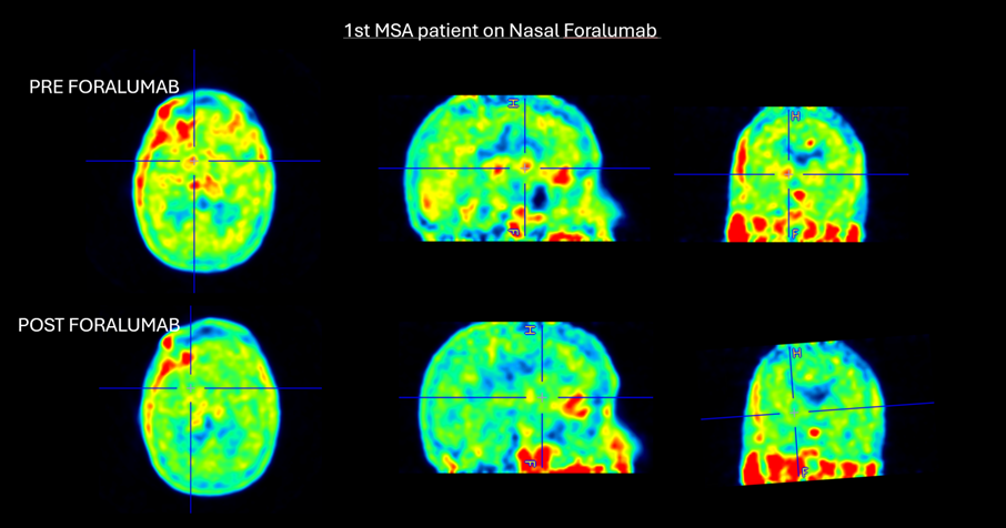 Figure 3. 1st MSA patient on nasal foralumab