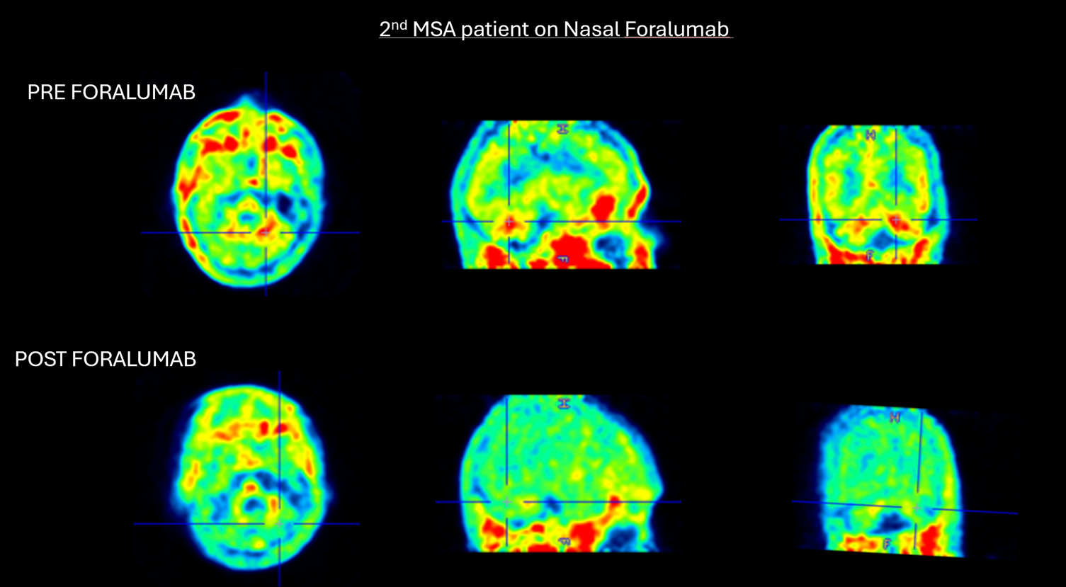 Figure 2. 2nd MSA patient on nasal foralumab