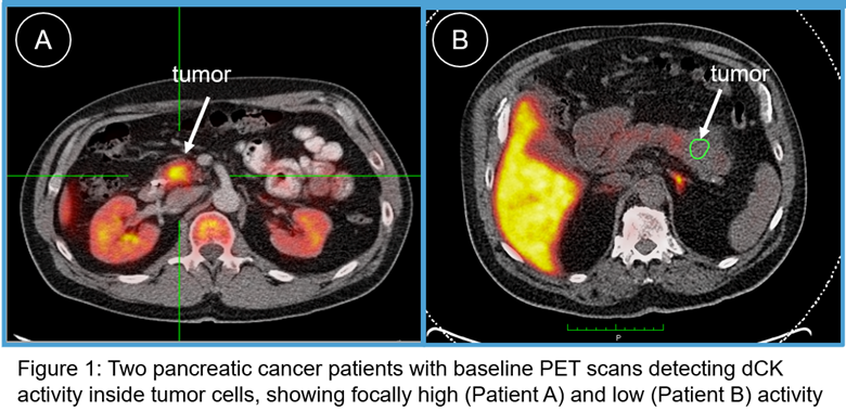 Two pancreatic cancer patients with baseline PET scans detecting dCK activity inside tumor cells, showing focally high (Patient A) and low (Patient B) activity