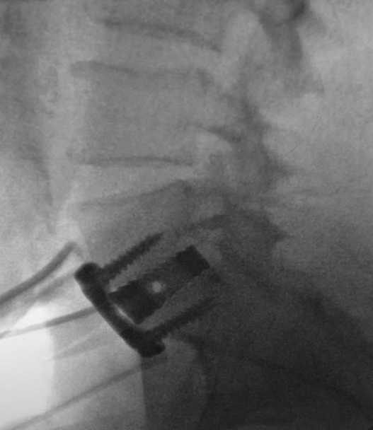 ALIF IdentiTi-LW Porous Titanium Interbody Implant