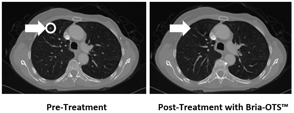 Treatment with Bria-OTS™ monotherapy resulted in 100% resolution of tumor in the lung of the MBC patient following 4 injection cycles (1)