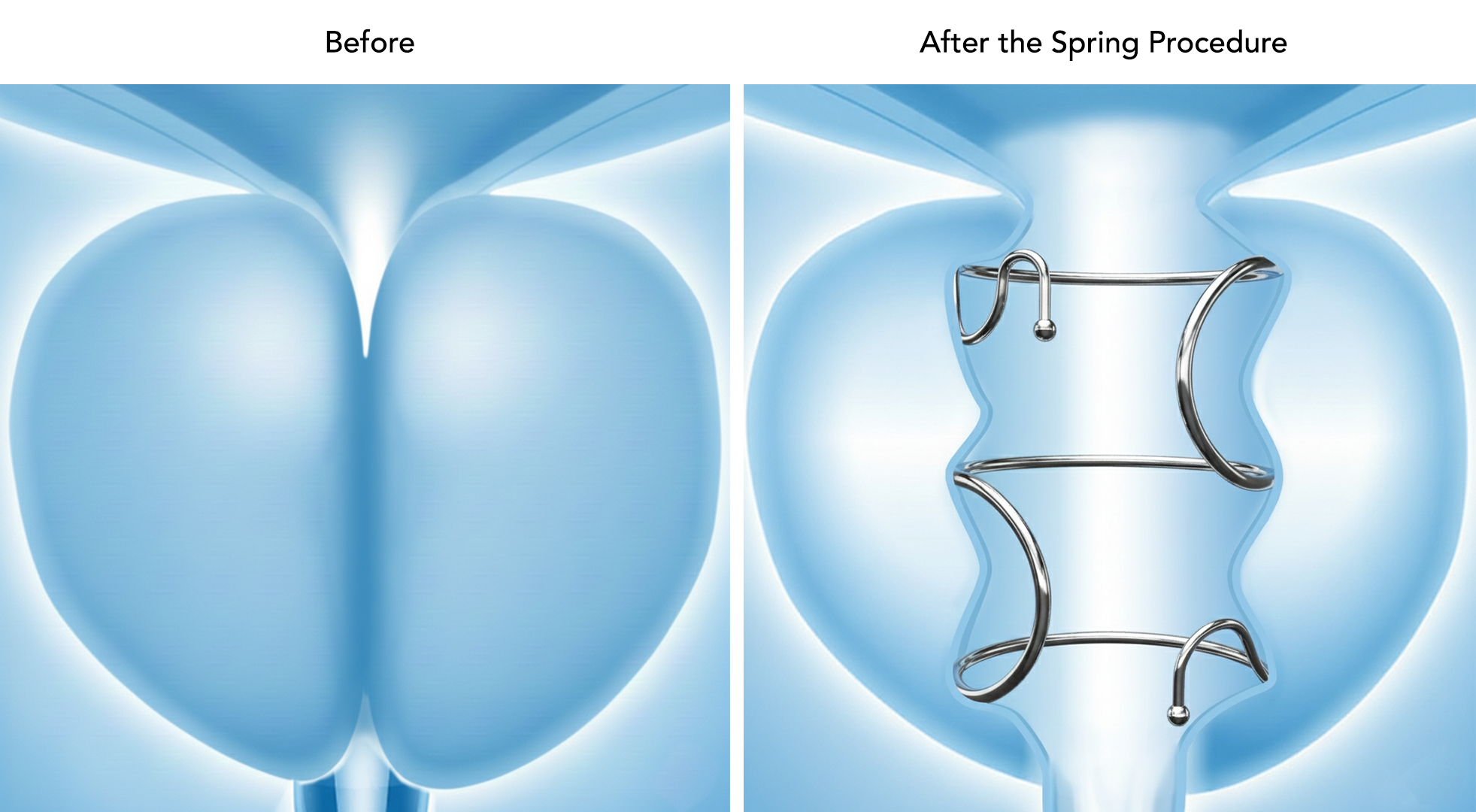 FDA Approves the Zenflow Spring® Implant and Delivery System for First-Line Interventional Therapy of Patients with Benign Prostatic Hyperplasia (BPH)