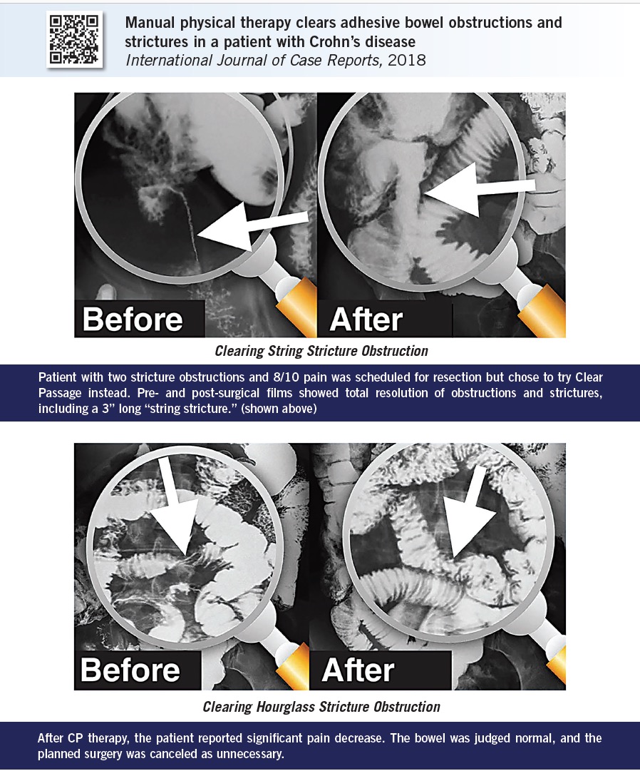 Before and after films of the intestines show that a unique, hands-on physical therapy cleared life-threatening bowel obstructions, eliminating the need for surgery.