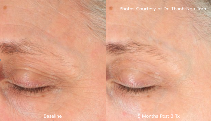 Wrinkle B&A - 5 Months Post 3 Tx