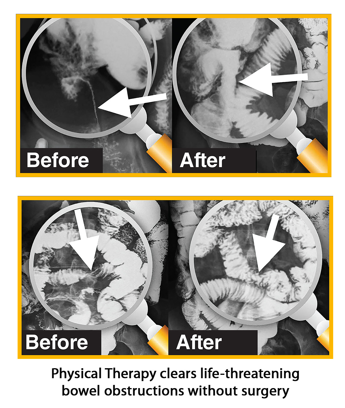 Before and after films of the intestines show that a unique, hands-on physical therapy cleared life-threatening bowel obstructions, eliminating the need for surgery.