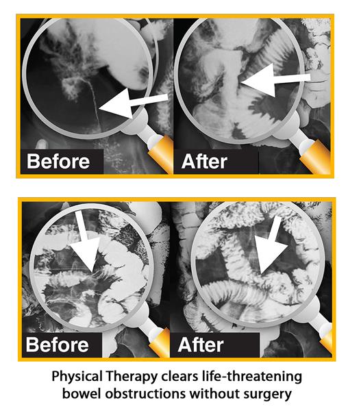 Before and after films of the intestines show that a unique, hands-on physical therapy cleared life-threatening bowel obstructions, eliminating the need for surgery.