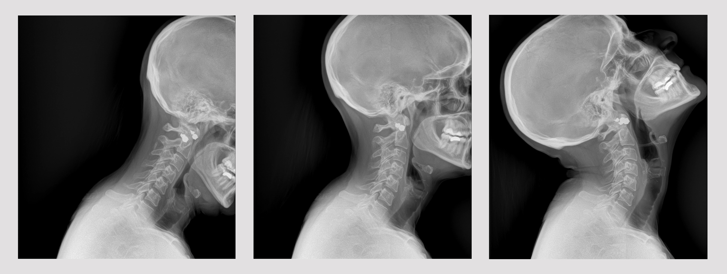 Dynamic Digital Radiography (DDR) is the next evolution in X-ray, enabling clinicians to view the dynamic interaction of anatomical structures, such as tissue and bone, with physiological changes over time.