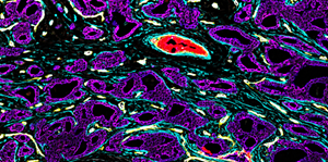 The CODEX® Solution can help researchers build comprehensive tissue maps for decoding disease biology. In this case, CODEX® detected the presence of a rare cell type (<0.1%, Ker8+/Ker14+), shown in the inset as red cells with a faint magenta outline, which had been previously reported only in healthy breast tissue. Researchers are still characterizing the role of this cell type in breast tissue behavior.