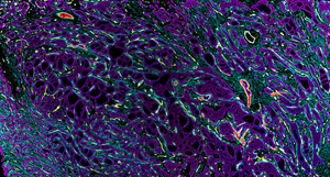 Shown here is a breast cancer sample (FFPE) where 36 biomarkers were imaged from a single tissue section using the CODEX® system. This particular tissue is largely composed of luminal epithelial tissue (purple) with basal epithelial cells (red) and other epithelial cells in smaller proportions. The luminal vs basal subtypes can be indicative of prognosis and treatment response.