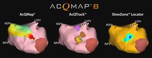 Case Example: Patient with Atrial Fibrillation Left to right, AcQMap (with input from a clinical specialist), AcQTrack, and SlowZone Locator all independently identify conduction abnormalities in the same anatomical location, providing confidence that the overlapping areas may be contributing to the complex arrhythmia. Physicians can leverage these algorithms to personalize treatment and potentially improve outcomes. AcQMap: Non-contact whole chamber propagation map uniquely enables visualization of cardiac activity during complex arrhythmias such as AF. AcQTrack: Algorithm that automatically identifies abnormal conduction patterns that may be drivers and/or maintainers of complex arrhythmias such as AF. SlowZone Locator (Composite Maps): Algorithm that automatically identifies zones of consistent slow conduction over multiple cycles or maps, which may sustain complex arrhythmias such as AF.
