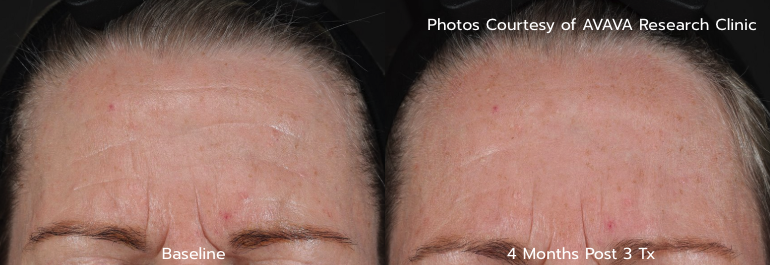 Wrinkle B&A - 4 Months Post 3 Tx