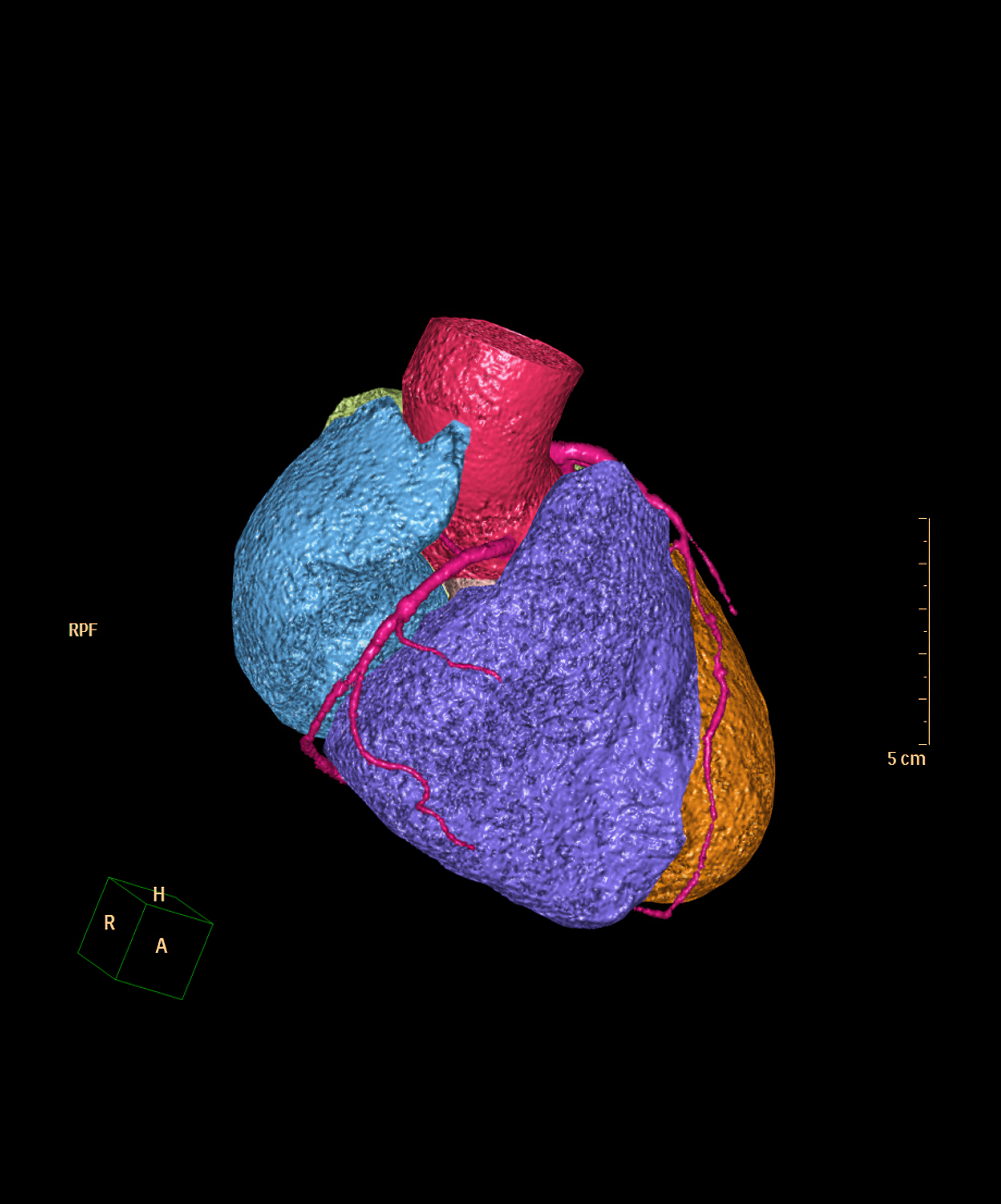 Image of CT Scan for Coronary Artery Disease 