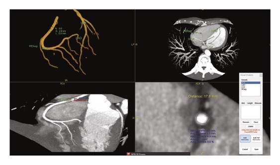 NovaCardio in NovaPACS EI 9.1 provides advanced cardiac visualization and analysis within the PACS environment, helping cardiologists review and evaluate cardiac studies without moving between separate systems.