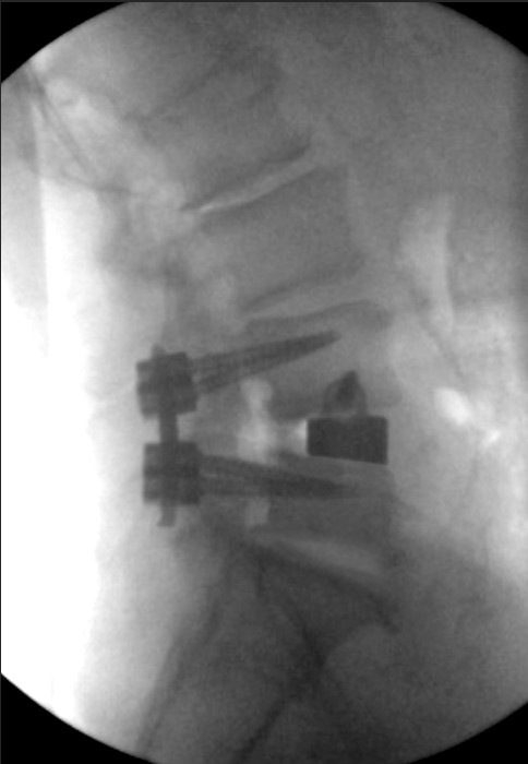 IdentiTi- LIF Titanium Interbody Implant