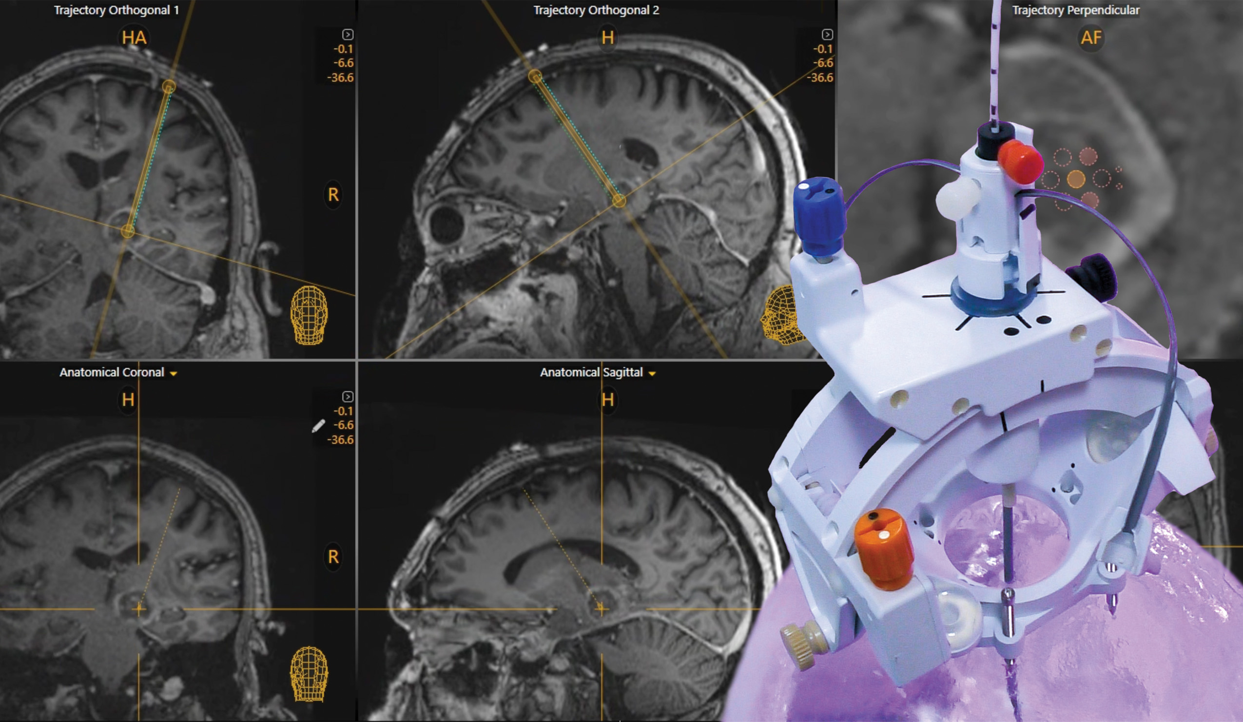 SmartFrame Array® Neuro Navigation Platform