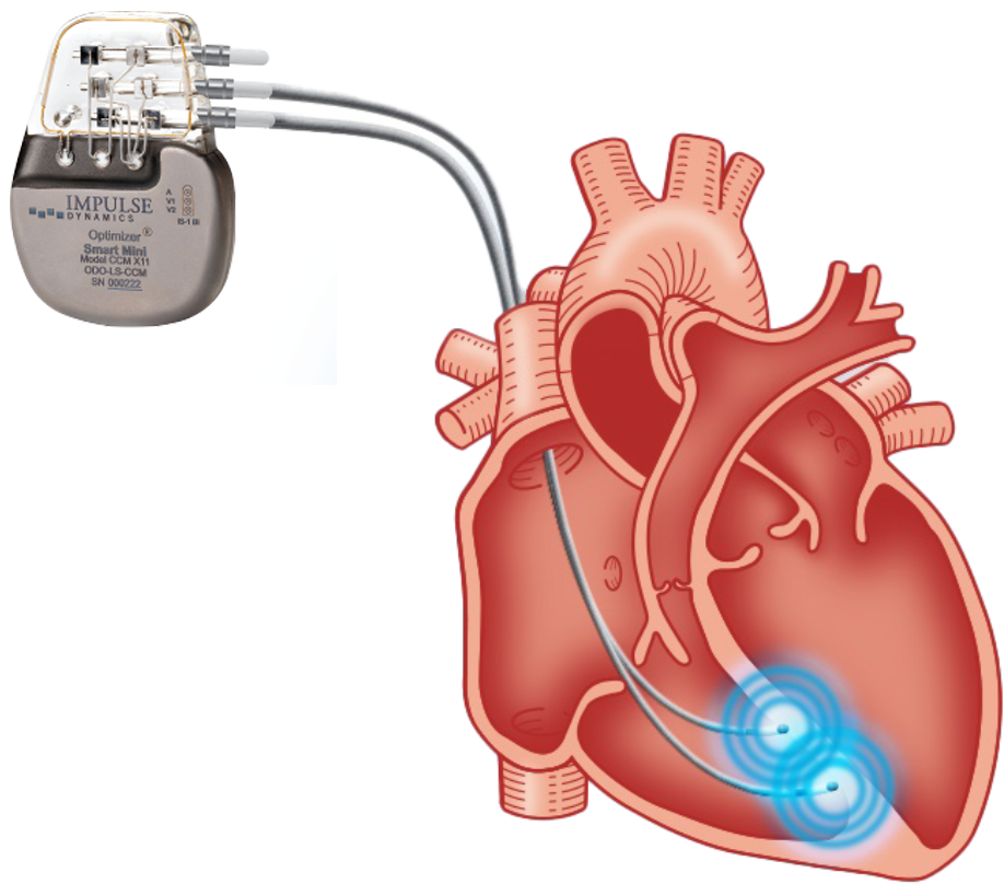 Optimizer® Smart Mini System With Leads Into the Heart