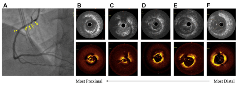 Figure 1: Before percutaneous coronary intervention 