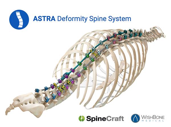 ASTRA Deformity Spine System
