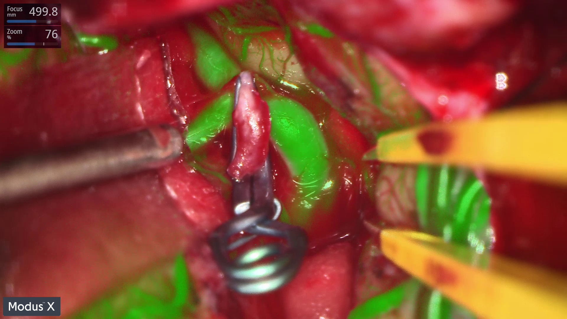 Modus X - ICG aneurysm