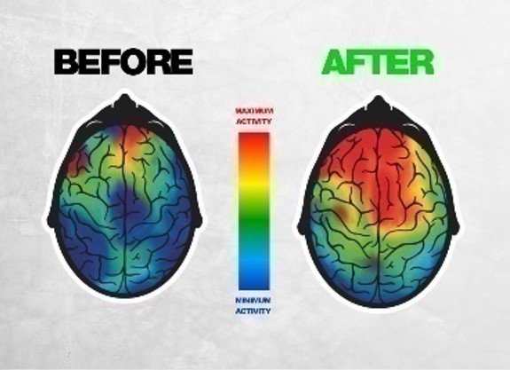 Actual EEG Brain Scan Before and After UBN ACTIVATE