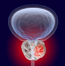 Artist interpretation of a growing prostate tumor