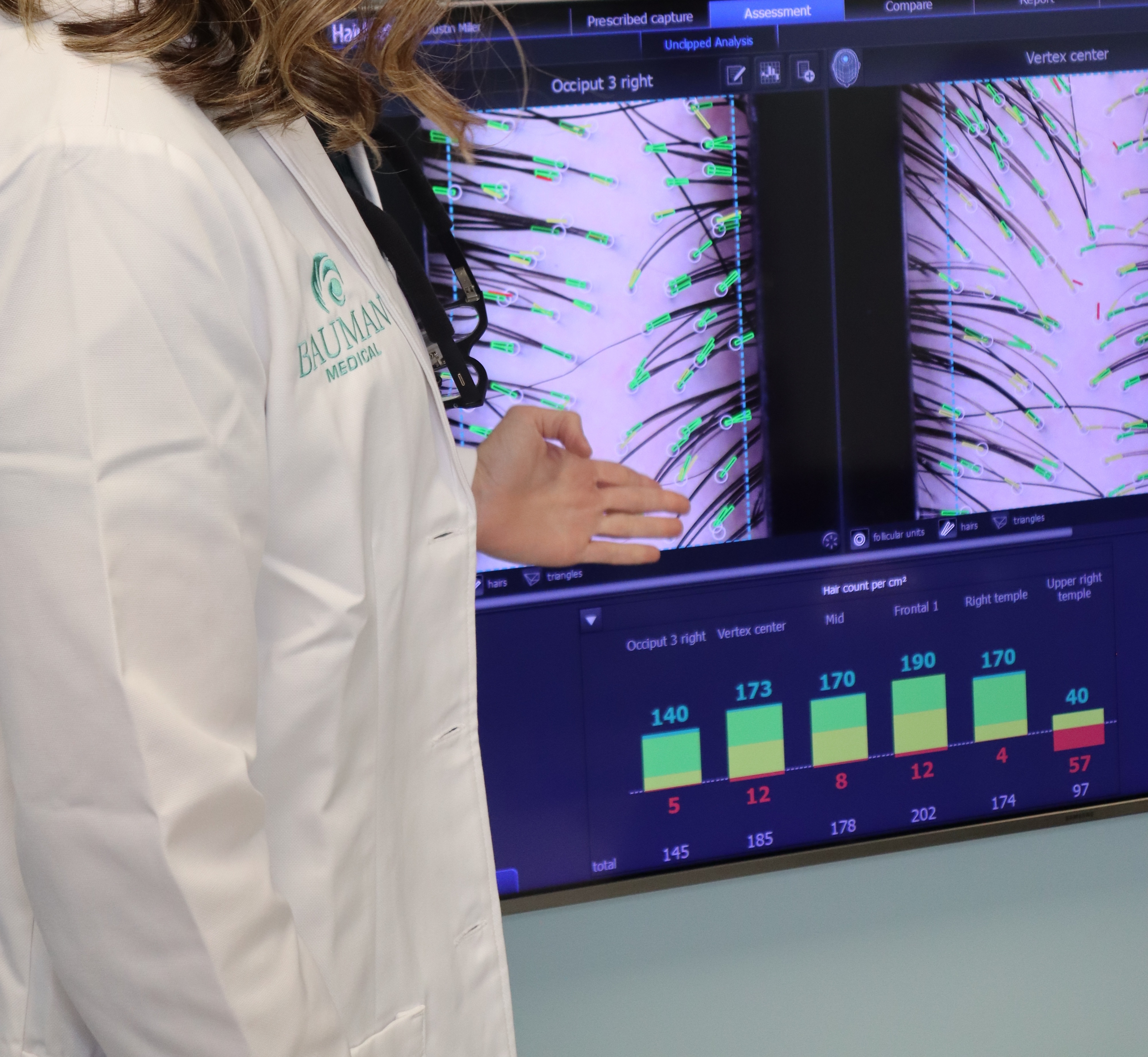 AI-Powered Hair Density Analysis at Bauman Medical