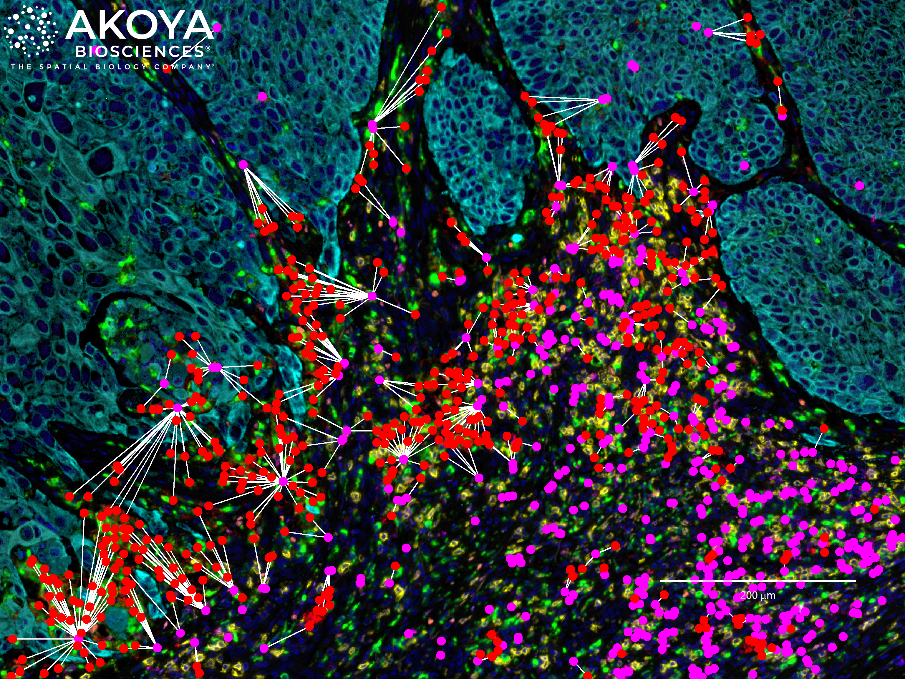 Scientists then use Akoya’s Spatial Analysis software for visualizing and making proximity measurements for different cell types. Shown here are PD-1+ cells (magenta) within 25μm of tumor-associated macrophages (TAMs, in red). The presence of TAMs are associated with inflammation, immunosuppression, and drug resistance. Furthermore, in certain cancers the level of TAM infiltration can serve as a prognostic indicator of overall survival.