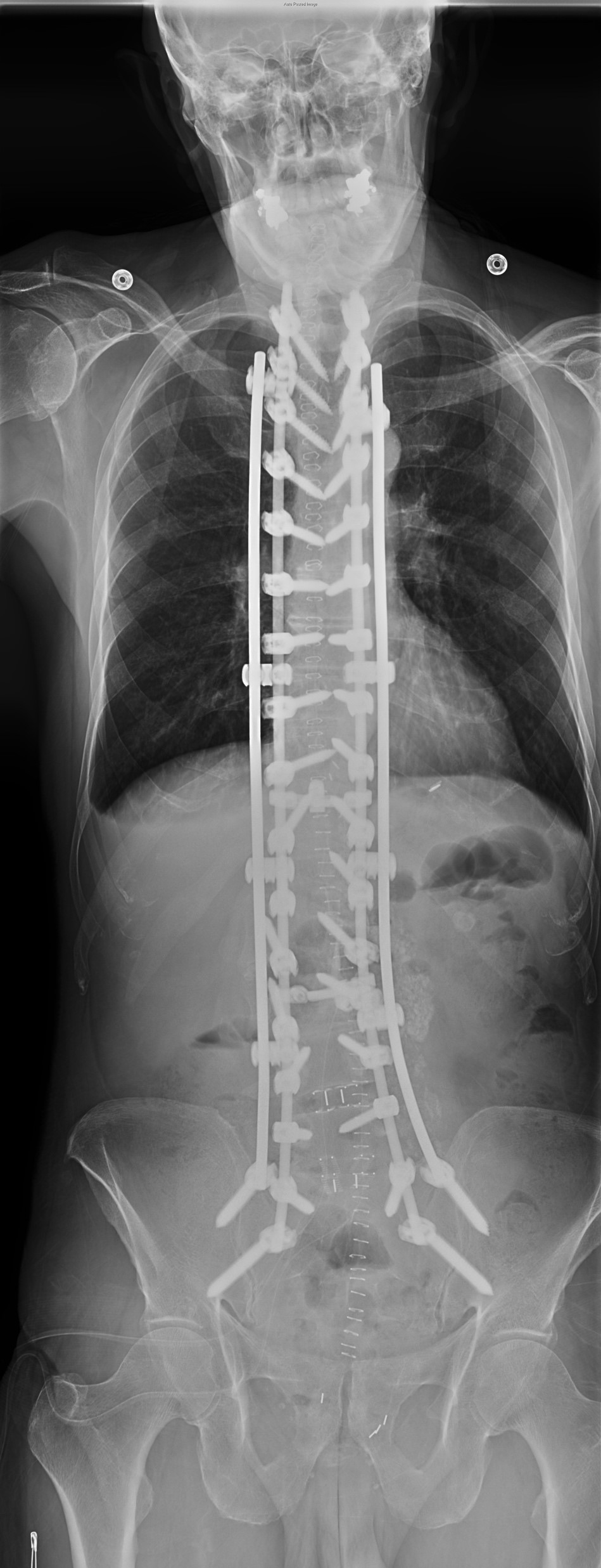 InVictus Open Spinal Fixation System