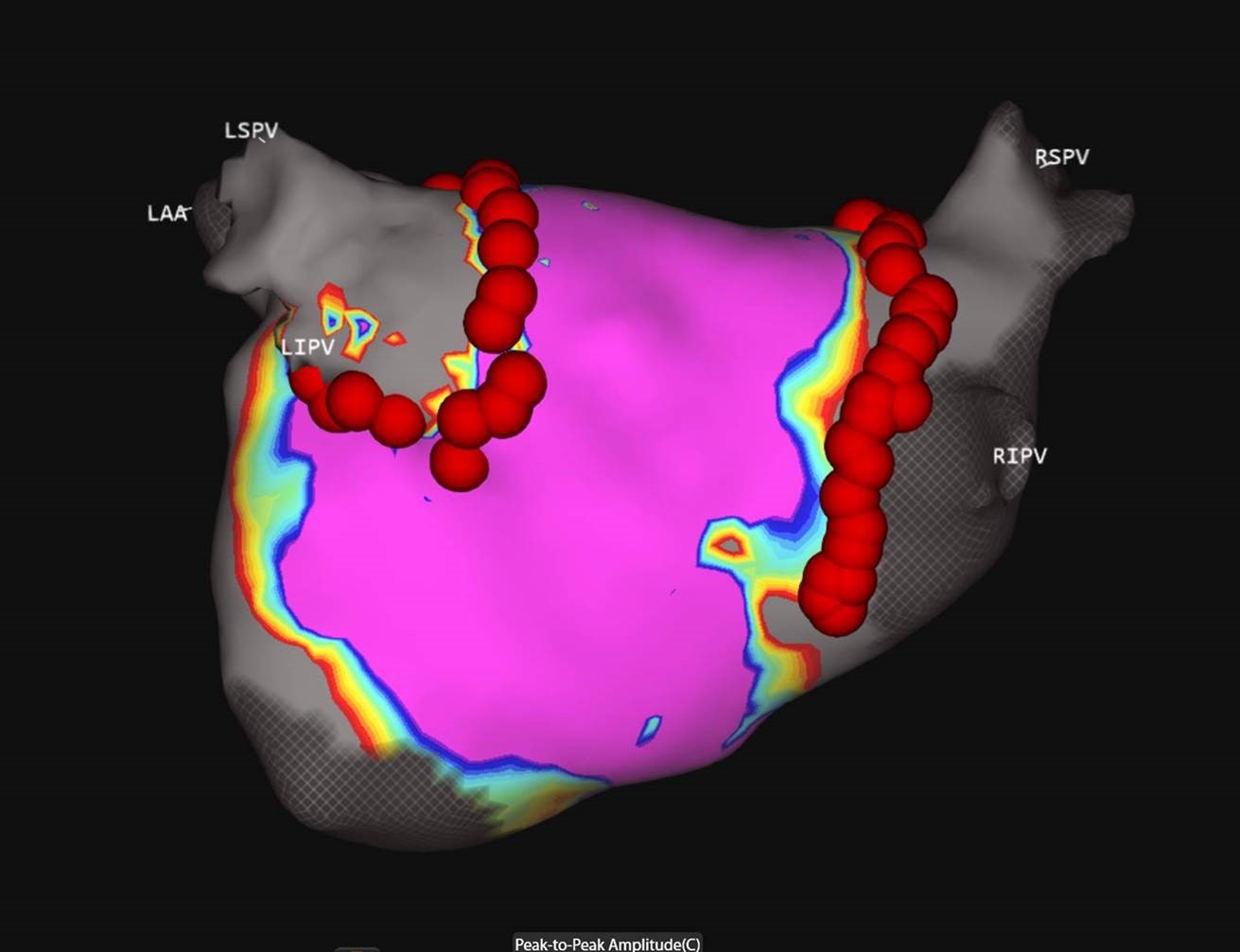 Acute Pulmonary Vein Isolation Confirmed Utilizing Acutus Technology with SuperMap