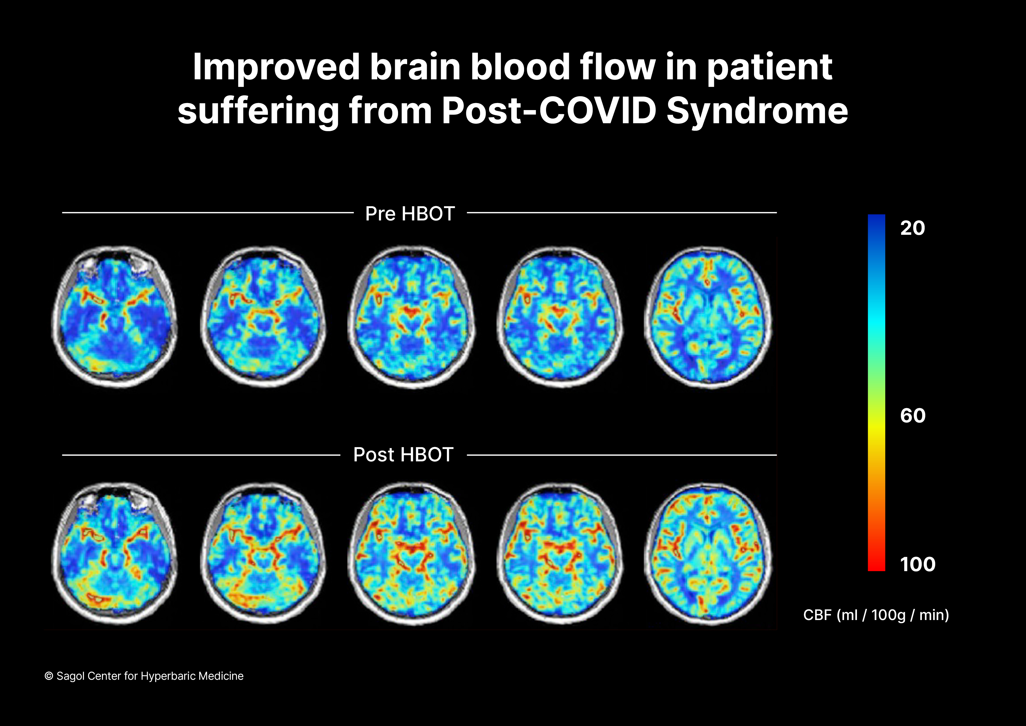 brain-blood-flow-pre-post-hbot-sagol_center_for_hyperbaric_medicine