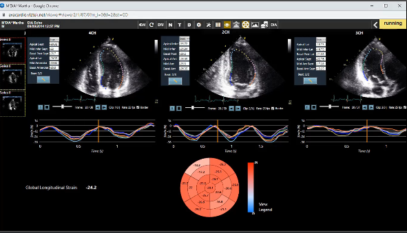 LVivo Strain on Exa Cardio PACS