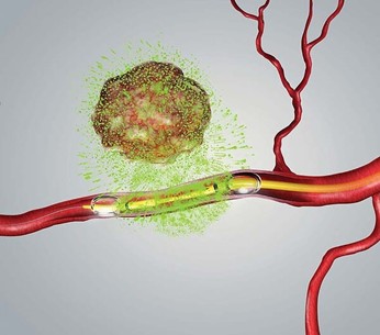 Illustration of RenovoCath delivering chemotherapy to tumor site via peripheral vascular system 
