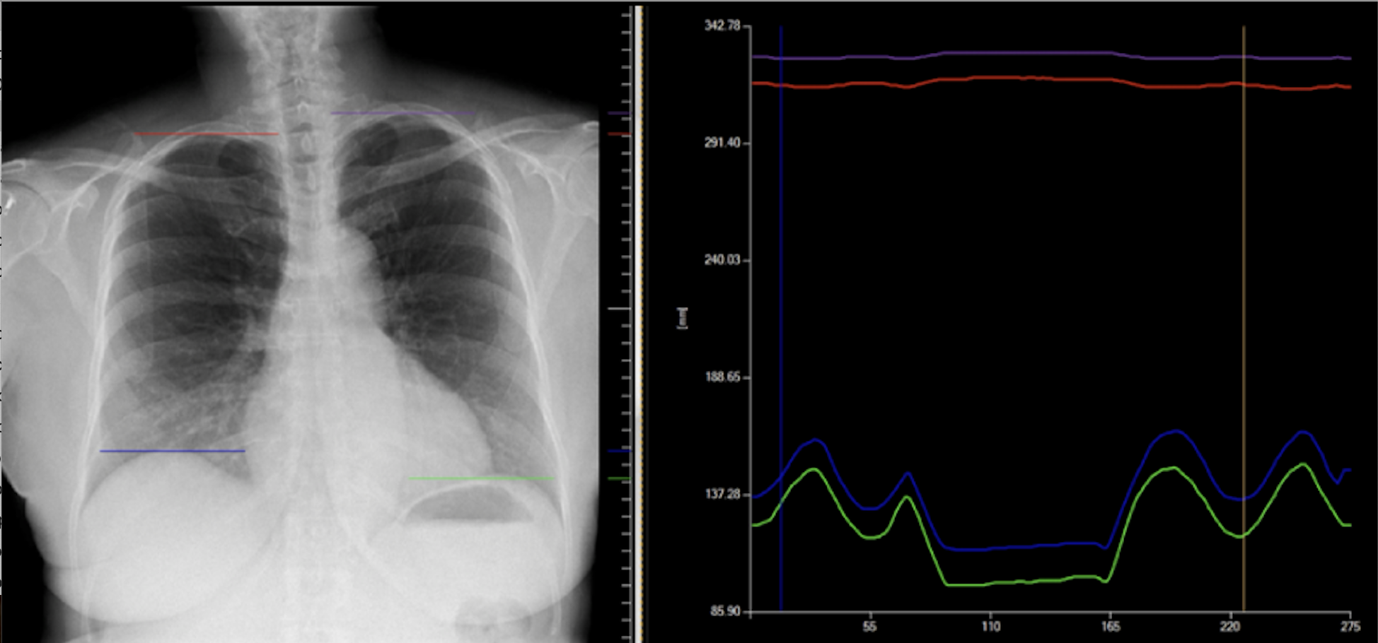 Konica Minolta's IWS workstation processes and quantifies Dynamic Digital Radiography diaphragmatic motion data.