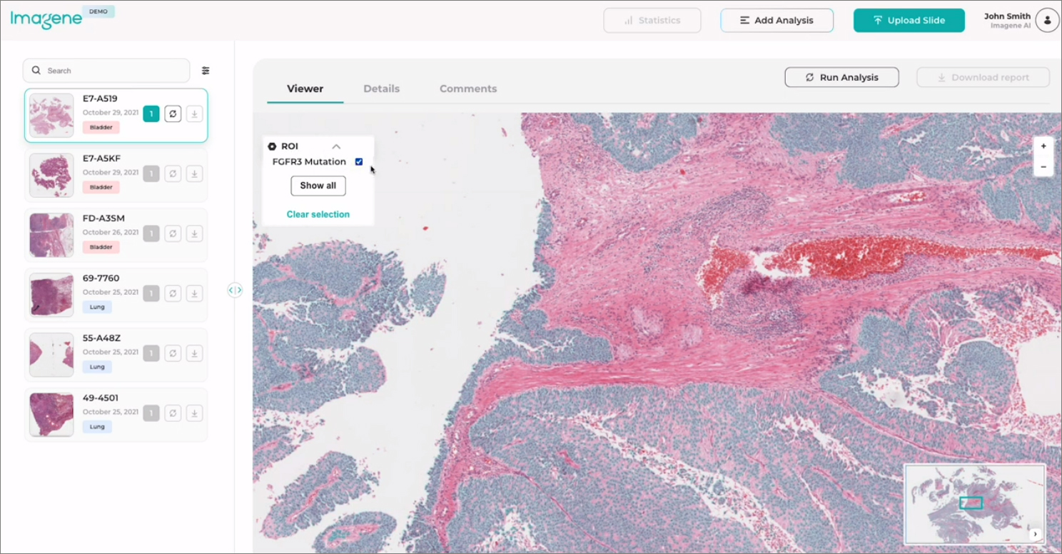 Image-based detection of FGFR3 fusion in urothelial bladder cancer