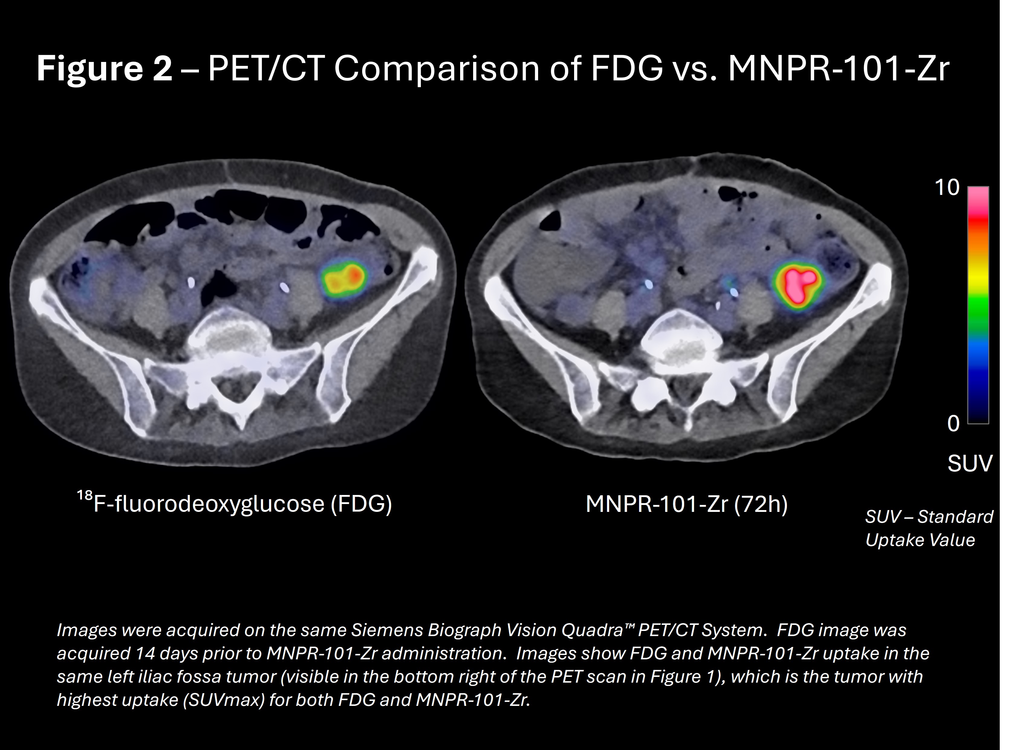 PET/CT Comparison of FDG vs MNPR-101Zr