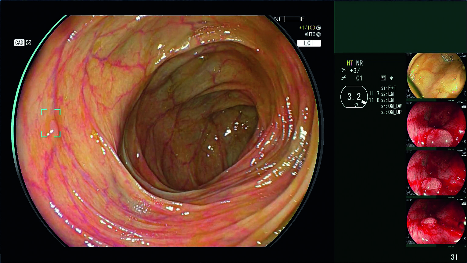 Fujifilm's AI System for Endoscopy - CAD EYE 