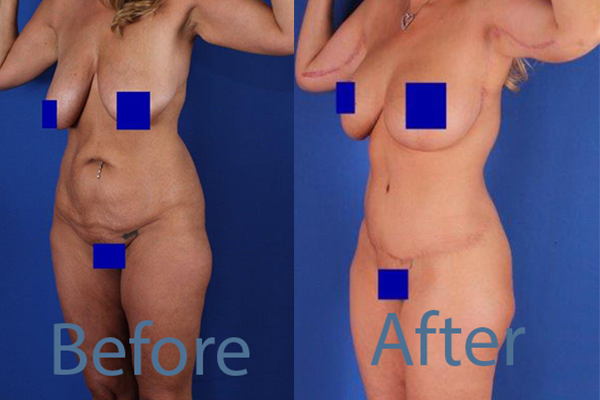 Before and 6 months After Oblique Flankplasty with Lipoabdominoplasty followed by Brachioplasty (arm lift) and breast and upper body lift in a 100-pound weight loss 42-year-old female patient.