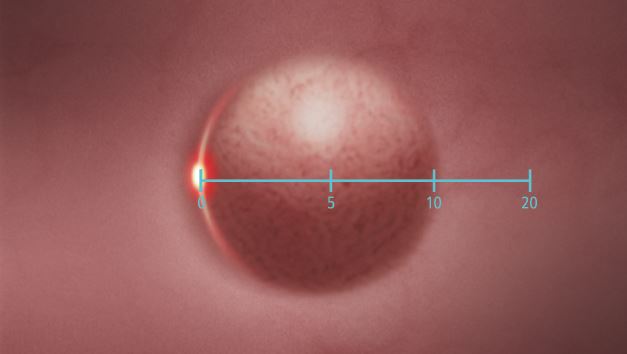 The virtual scale was designed to support endoscopists estimate the size of lesions.