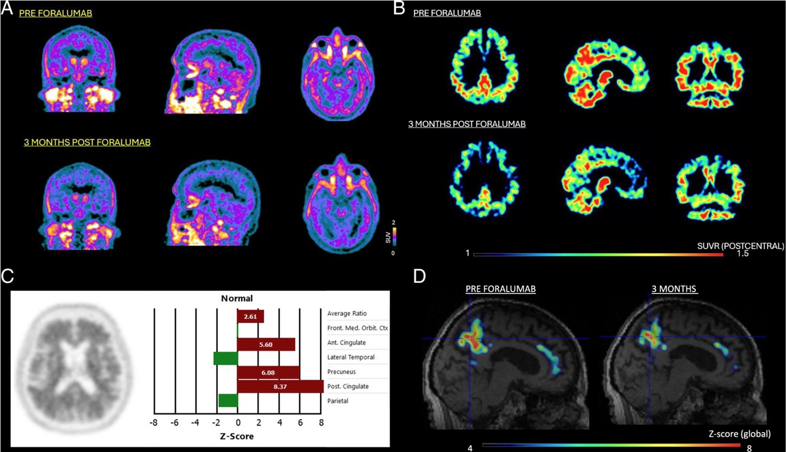Journal of Clinical Nuclear Medicine Publishes Results of Tiziana’s Nasal Foralumab in Study Treating Moderate Alzheimer's Disease