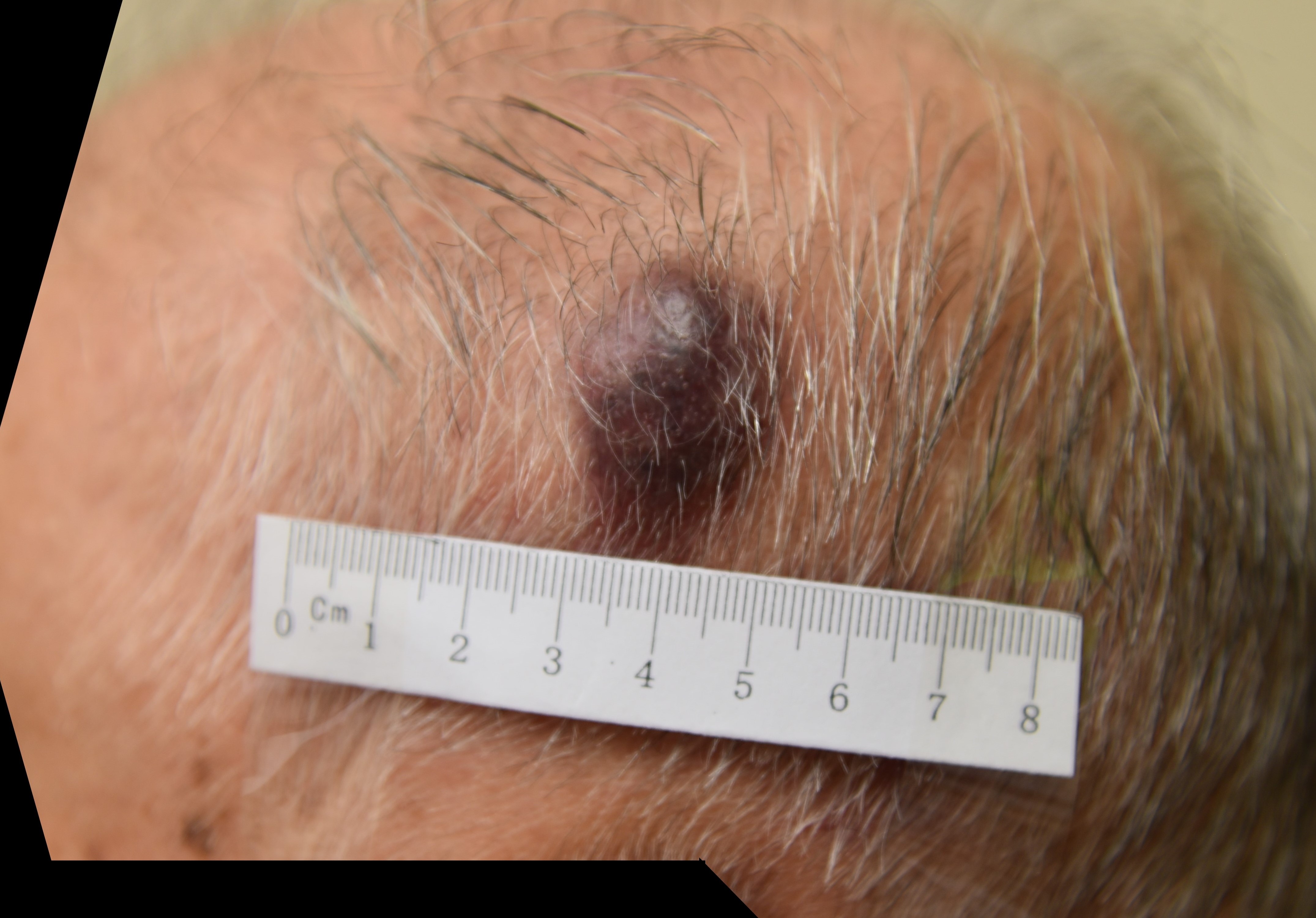 Patient A (Aged 93): Baseline