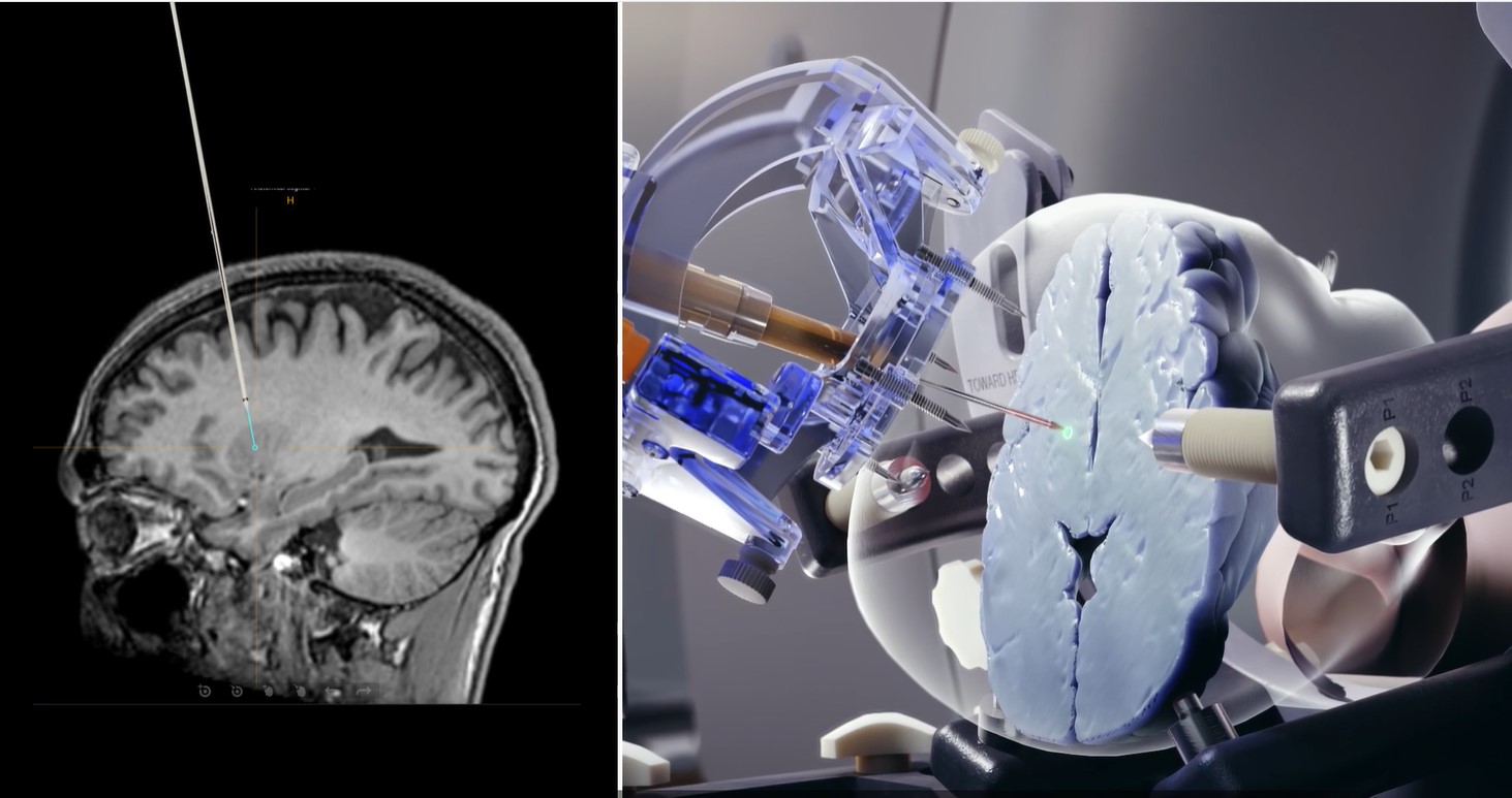 ClearPoint Neuro