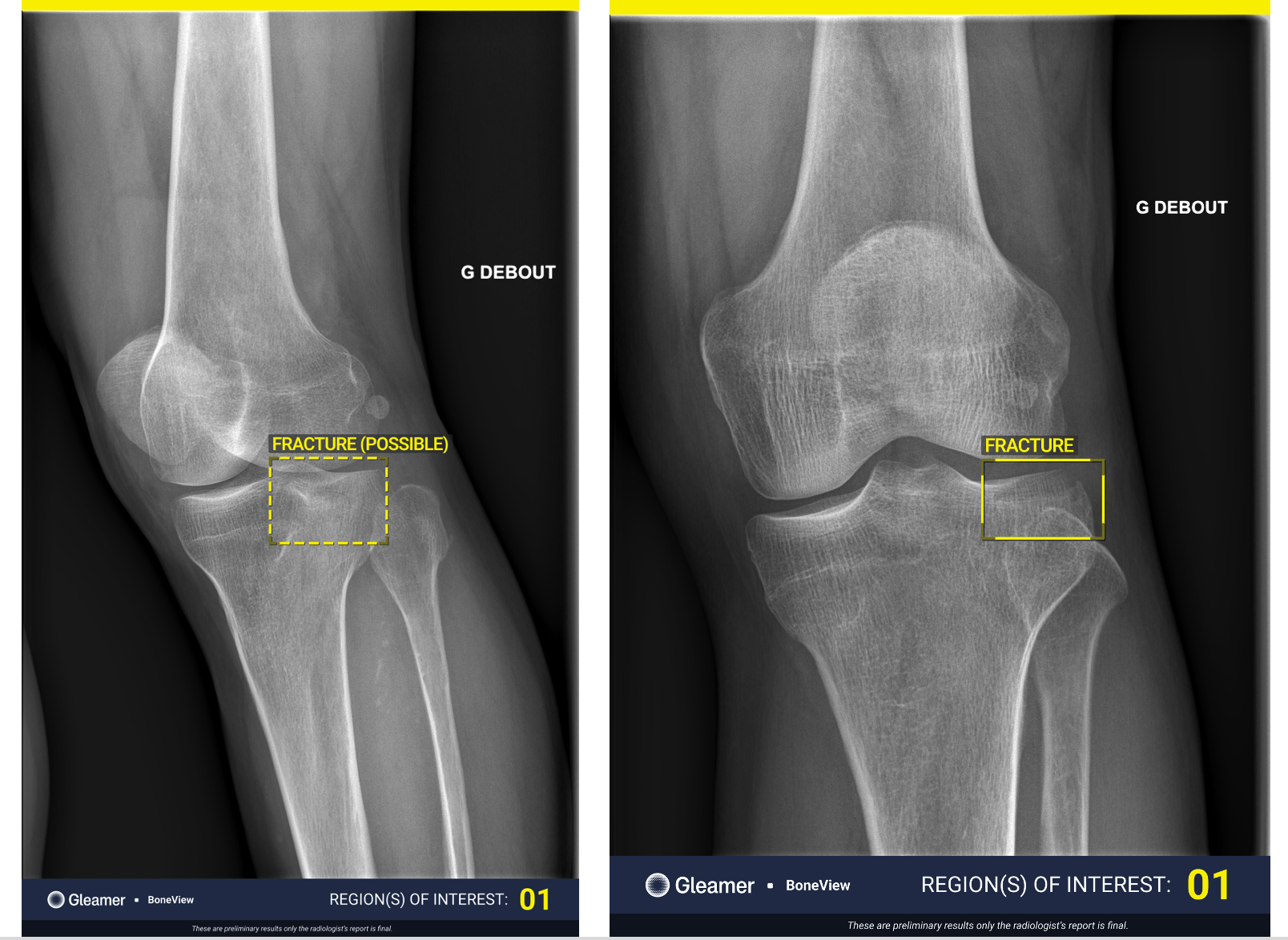 BoneView is a clinical decision support AI-based software solution designed to efficiently identify bone fractures by highlighting areas of interest on an X-ray image