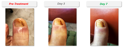 On day 1, pre-treatment X-rays showed an infection deep within the underlying bone, tissue, and around the nail, with signs of initial biofilm formation. After three days of R327G treatment, the wound dried up with the infection clearing, and the toe responded well to treatment. On day 7, the wound completely dried up, with no signs of biofilm surrounding the toenail, and swelling had significantly reduced. Surgical intervention was averted, such as limb amputation, which is common in patients with diabetes.