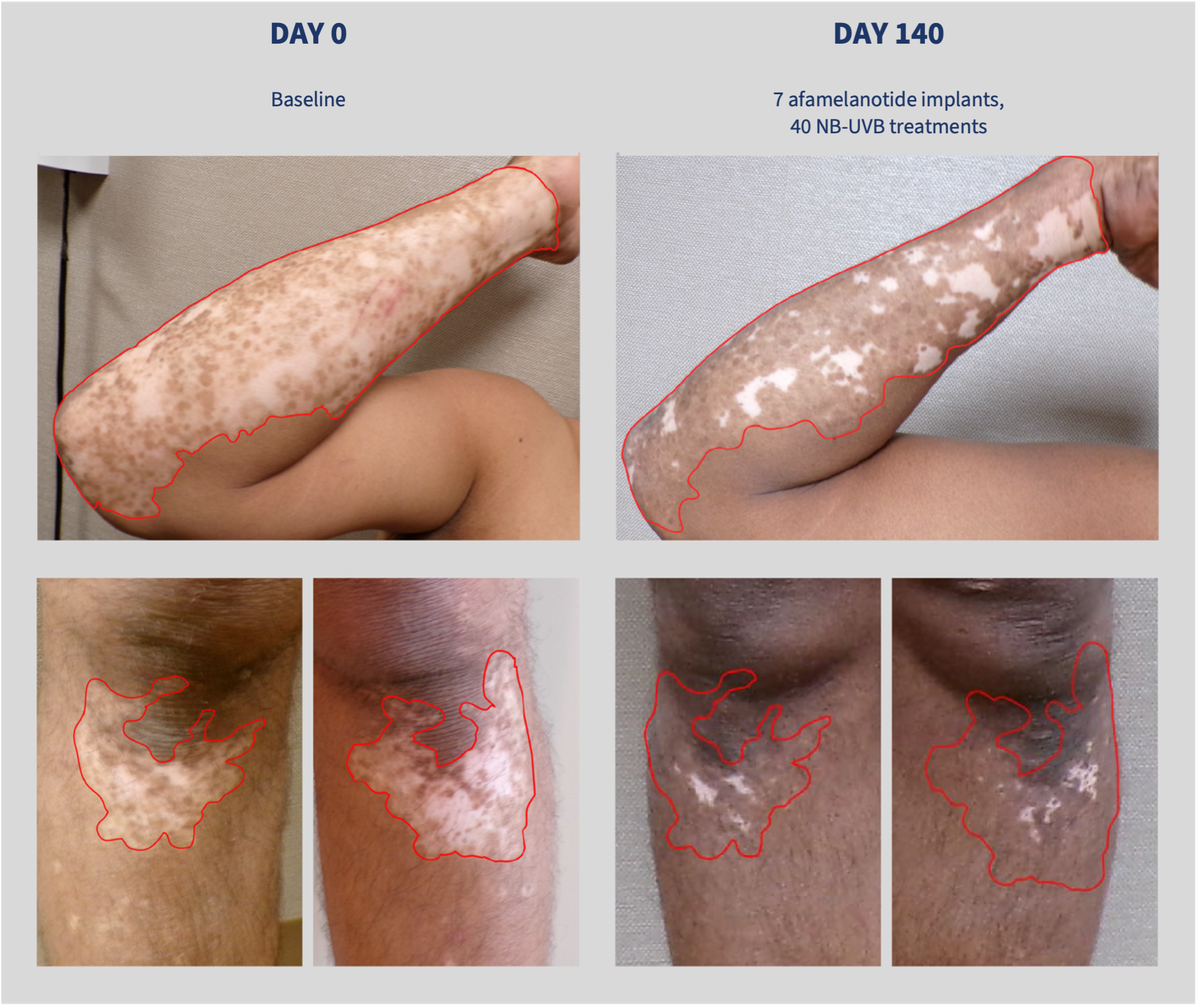 Repigmentation of vitiliginous lesions on the right forearm of a patient. 